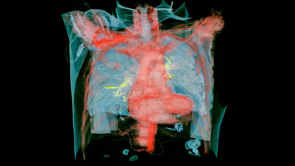 Josiah Child’s CT scan visualization showing multiple pulmonary emboli (yellow)